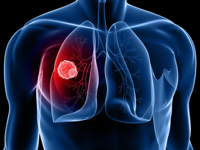 lung cancer lung cancer