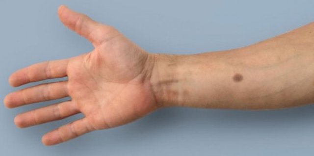 An artificial mole can detect major cancers very early An artificial mole can detect major cancers very early