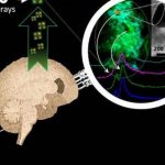 Metals in the brain drive Alzheimer’s disease