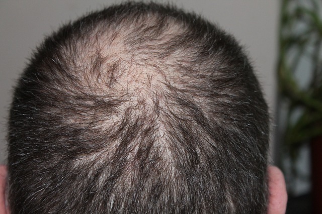This treatment could help regrow your hair This treatment could help regrow your hair