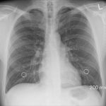 Obesity can increase risk for dangerous lung clots in COVID-19