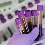 Blood test may predict Alzheimer’s disease accurately, study finds