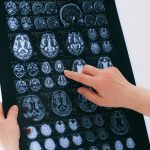 Scientists find the key cause of the spread of cancer to the brain