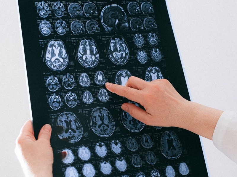 Scientists find the key cause of the spread of cancer to the brain