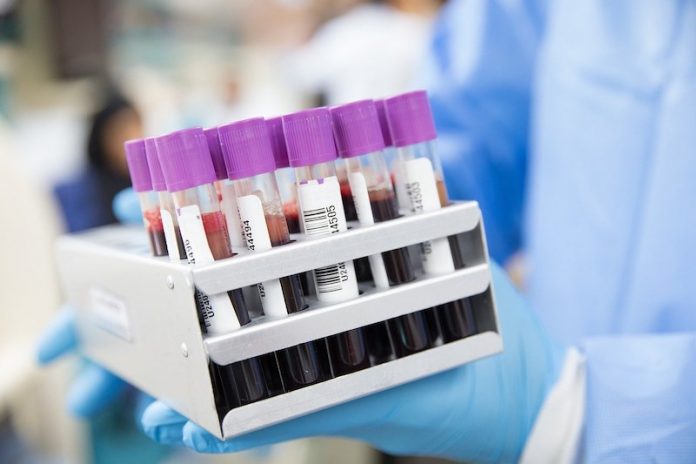 This study shows new way to prevent deadly blood clotting