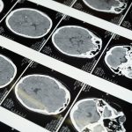 COVID-19 can infect neurons and damage brain tissue, Yale study shows