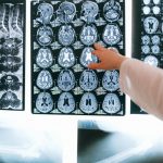 Century of data show COVID-19 could harm the brain