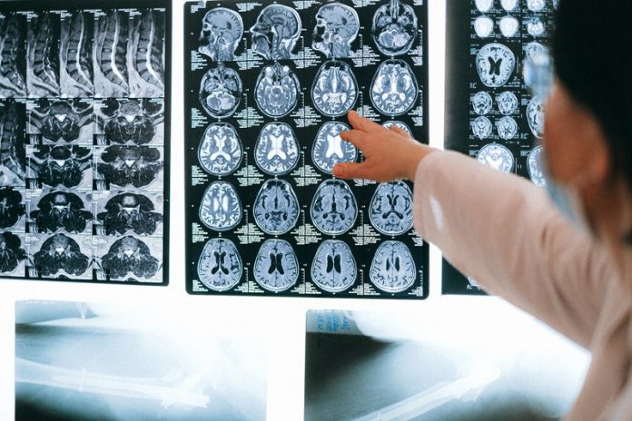 Scientists find blood vessel damage and inflammation in COVID-19 patients’ brains