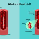 Blood clots: 10 things you need to know