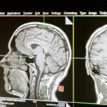 Head injuries may worsen cognitive decline decades later