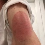 Moderna COVID-19 vaccine may cause this skin reaction, study finds