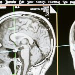 Scientists find new method to treat brain cancer