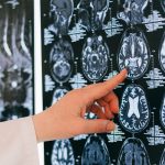 Scientists find new method for early detection of Alzheimer’s