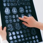 This brain problem can increase risk of stroke for up to five years