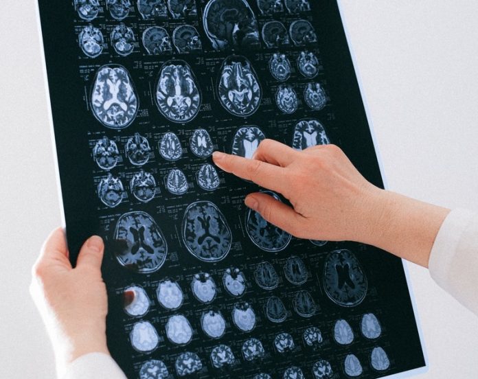 This brain problem can increase risk of stroke for up to five years