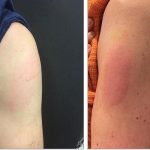 Moderna vaccine can cause red, itchy ‘COVID arm’ for a short time