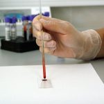 High insulin levels may cause pancreatic cancer, study finds