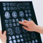 This new treatment may stop development of Alzheimer’s disease
