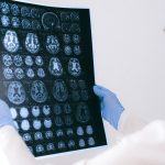 Scientists find new way to detect brain cancer early