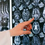 Why strokes harm women, men in different ways
