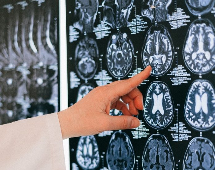 Why strokes harm women, men in different ways