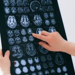 COVID-19 may strongly affect your brain