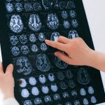 This new method can predict Alzheimer’s disease with nearly 100% accuracy
