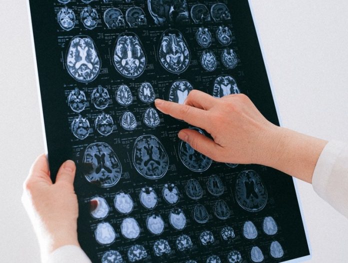This new method can predict Alzheimer’s disease with nearly 100% accuracy