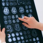 Scientists find a new way to detect Alzheimer’s disease early
