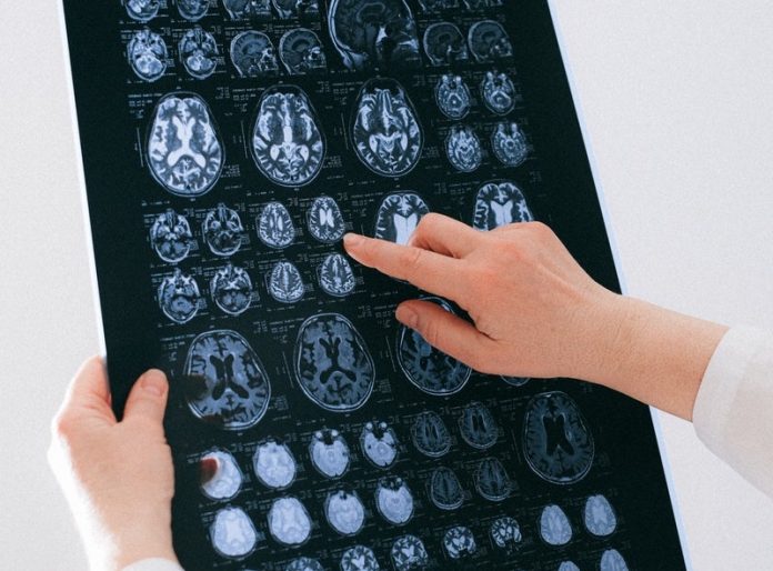 Scientists find a new way to detect Alzheimer’s disease early