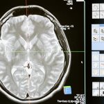 Scientists find how to predict Alzheimer’s disease with nearly 100% accuracy