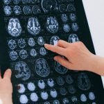How COVID-19 harms the brain, according to new study