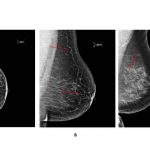 Mammograms may help predict heart disease and stroke risk