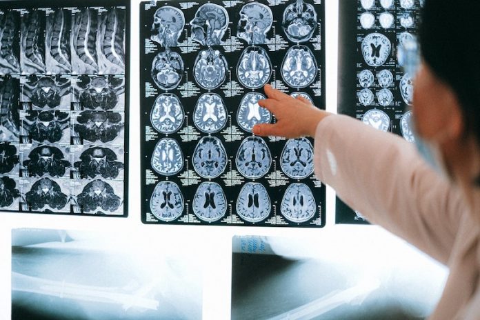 13% of hospitalized COVID-19 patients have serious brain damage