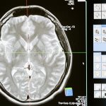 Scientists find the missing link between Alzheimer’s and blood vessel disease