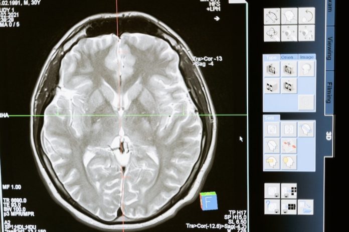Alzheimer’s disease linked to a bigger structure in the brain