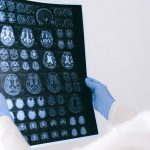 Anti-malarial drug may help treat deadly brain cancer