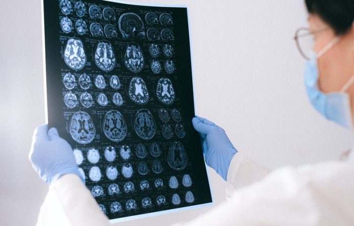 Brain damage could be severer in COVID-19 than in Alzheimer’s disease
