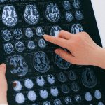 People with COVID-19 have a higher risk of Alzheimer’s, Parkinson’s