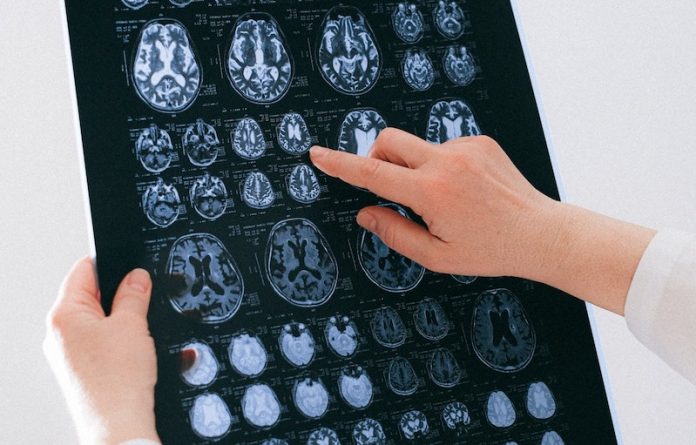 People with COVID-19 have a higher risk of Alzheimer’s, Parkinson’s