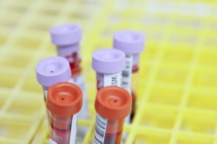 Scientists develop blood test for Parkinson’s disease