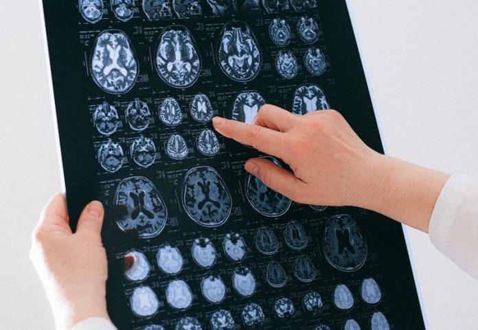 Stroke can cut life expectancy by one third