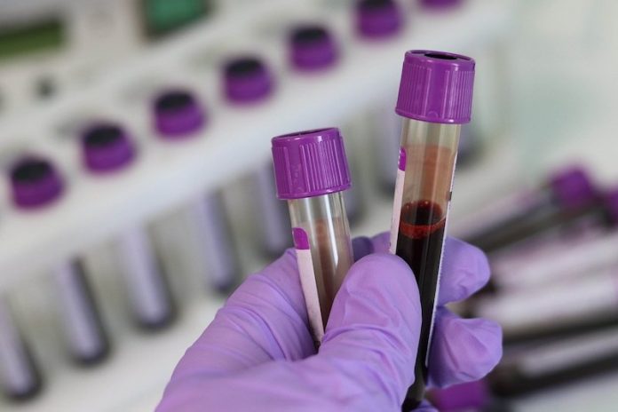 This new blood test can detect cancer, and whether it’s metastasised