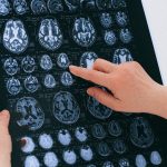 COVID-19 can increase stroke risk in younger patients, study finds