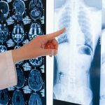 New drug combo may treat some lung cancer effectively