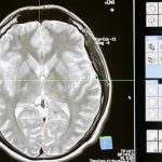 Parkinson’s disease: scientists find the earliest roots in the brain