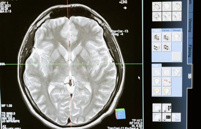 Parkinson’s disease- scientists find the earliest roots in the brain