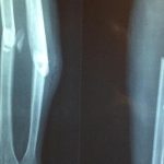 Diabetes may make bones less bendable, more prone to fracture