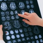 How COVID-19 infection may cause Alzheimer’s and Parkinson’s symptoms