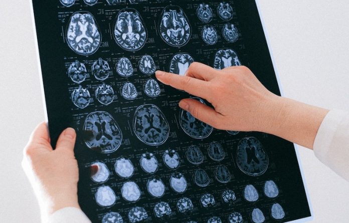 How COVID-19 infection may cause Alzheimer’s and Parkinson’s symptoms